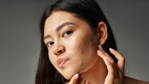 8 Diet Changes to Reduce Jawline and Chin Acne, Say Dermatologists